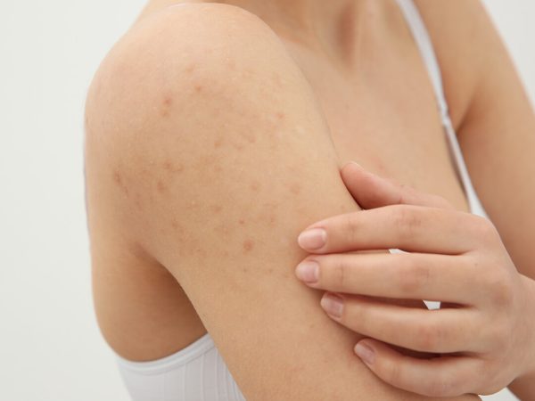 Homeo Dermatology Clinic In Guwahati Homeo Skin Doctor In Guwahati