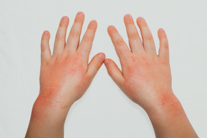 Homeo Dermatology Clinic In Guwahati Homeo Skin Doctor In Guwahati